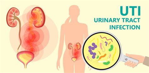 Urinary tract infections (UTIs): Causes, symptoms and treatment